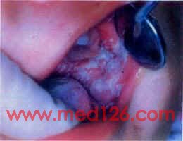口腔粘膜病治疗方法/临床表现诊断