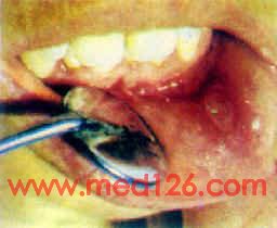口腔粘膜病治疗方法/临床表现诊断