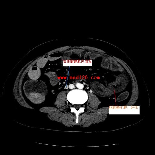 腔静脉及门脉系统广泛栓塞CT增强表现