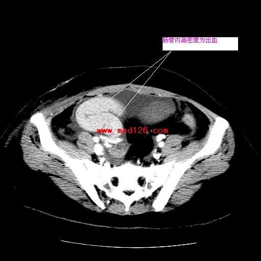 腔静脉及门脉系统广泛栓塞CT增强表现
