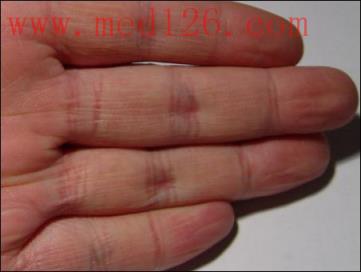 这是一只典型的气虚之手,大家注意四个手指肚全是瘪的,并有褶皱