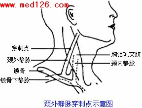 颈外静脉输液法图片