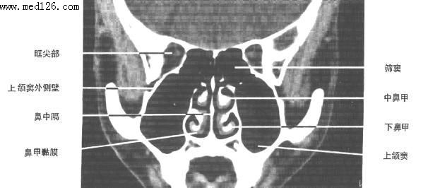 鼻窦ct图片断层解剖图片