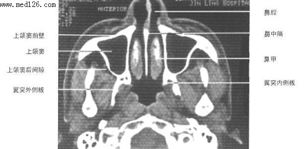 正常鼻咽部断层解剖图图片