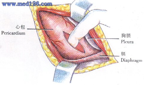 心包切开引流手术操作步骤,图片图谱图解,手术治疗方法,诊断心脏手术 