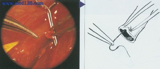 血管端侧吻合术图解图片