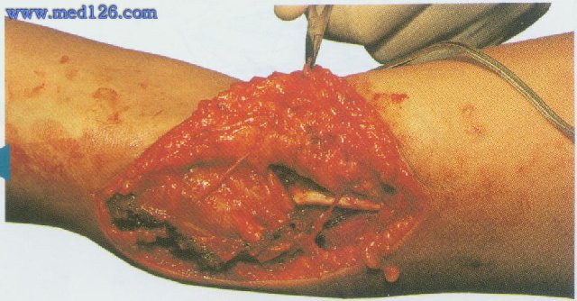 尺神经损伤手术刀口图图片