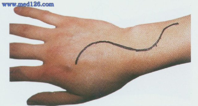 手部手术切口设计图片
